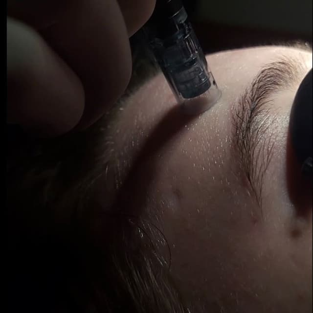 Microneedling 6 sessions at Be You Beauty - Esthetics LLC in Tucson, AZ